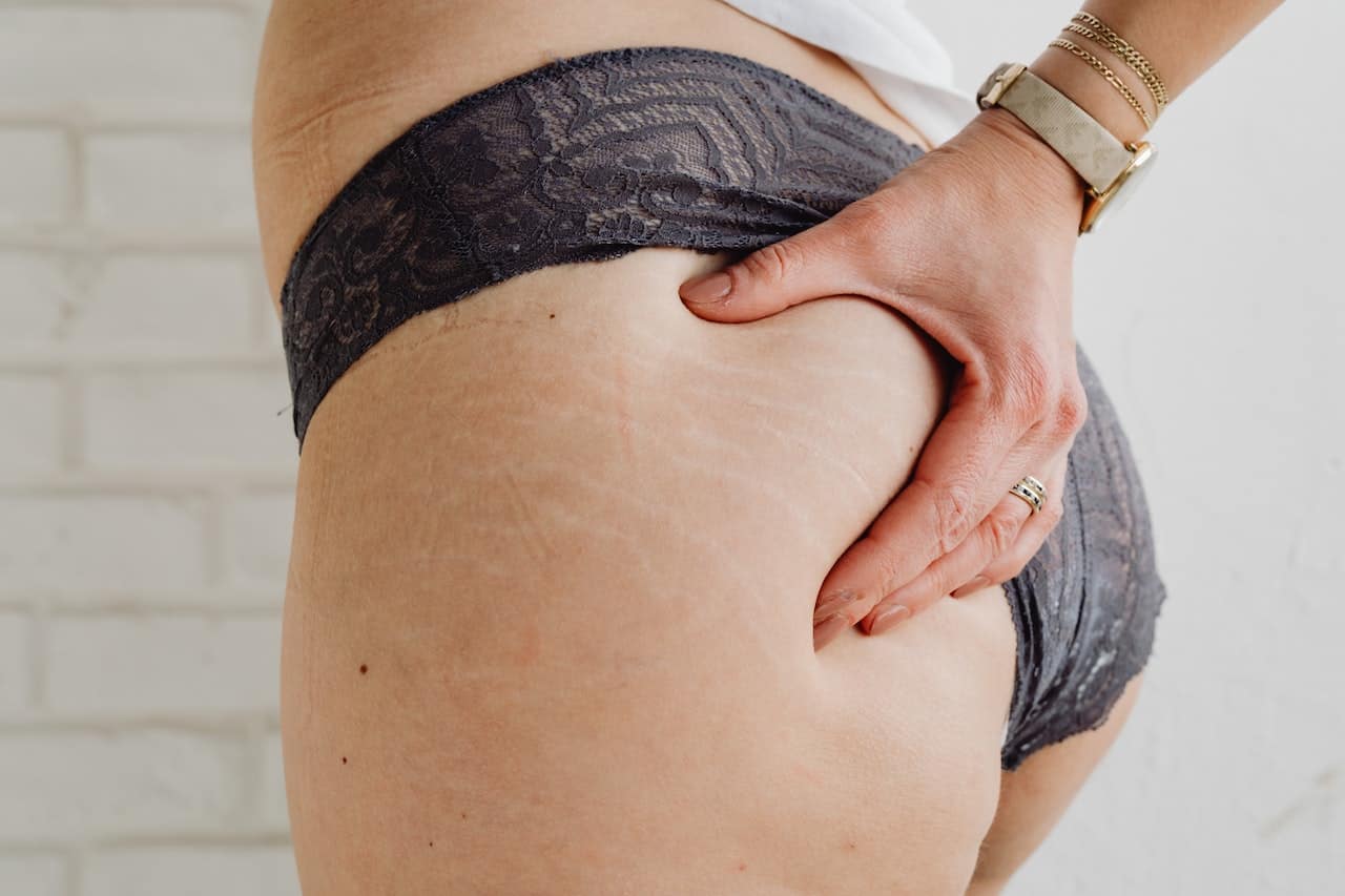 preventing stretch marks when losing weight